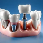 implant-dental
